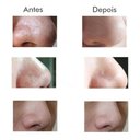 Ver imagem 7 de Máquina Sucção a Vácuo Remove Cravos Aparelho Acne Cleaning