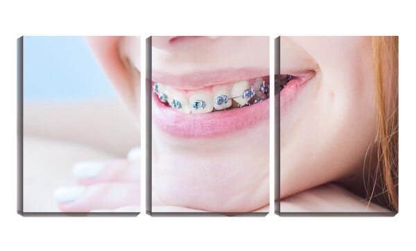 Quadro Decorativo 30x66 sorriso com aparelho odonto - 1