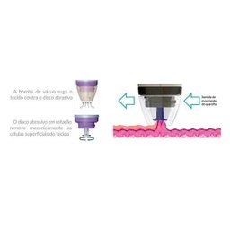 Aparelho De Peeling Portátil Microdermoabrasão IPeel - Basall - 6