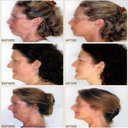 Ver imagem 4 de Aparelho Redutor de Papada Neckline Massageador Portátil