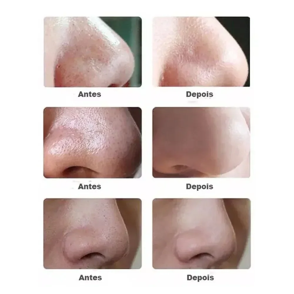 Ver imagem 4 de Aparelho Removedor Cravos e Espinhas