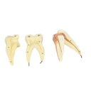 Ver imagem 4 de Dente Molar Superior C/ Raiz Tripla em 3 Partes, 8x